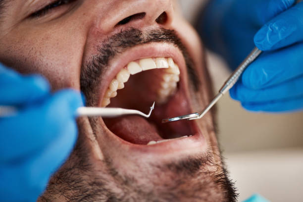 Best Emergency Dentist for Lost Fillings or Crowns in Plymouth, PA